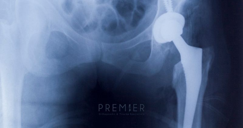 Xray image of hip joint replacement shows patients can require a joint replacement at any age. Premier Ortho logo at bottom center.